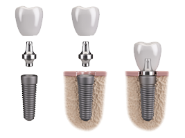 Akcijska cijena zubni implantati, All-on-4, All-on-6